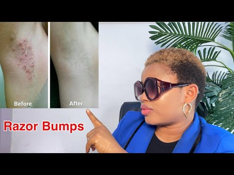 How to Get Rid of Unsightly Razor Bumps Now | Tend Skin