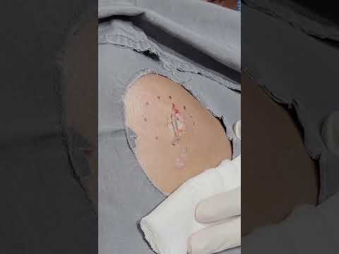 Good thing I've never seen spiders come out of cysts before...