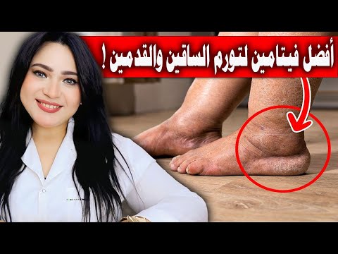 أفضل فيتامين لعلاج تورم القدم والساقين والكاحلين والتخلص من انتفاخ الرجلين مهما كان عمرك !