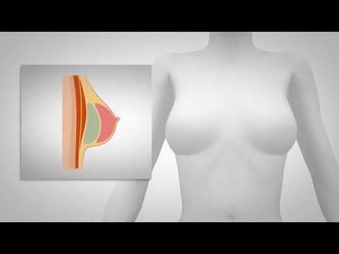 Breast Augmentation Pittsburgh