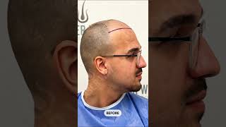 Hair transplant in Albania before and after result