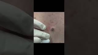 Watch These Blackheads Pop Out Instantly #asmr #skincare #satisfying