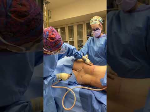 Dr. Mohan in the OR - Liposuction and Breast Augmentation
