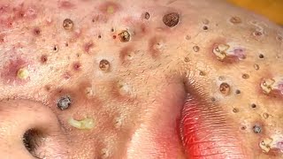 Loan Nguyen Acne Treatment 129c