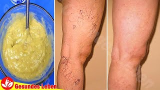 Ich Wende Dies Auf Beine - Es Entfernt Krampfadern Und Besenreiser Auf Den Beinen Schnell