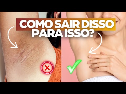 Como NÃO TER MANCHAS NAS AXILAS com a Esteticista