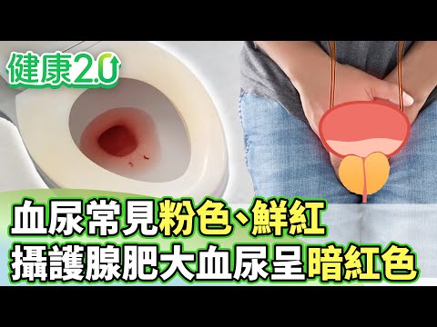血尿常見粉色.鮮紅攝護腺肥大血尿呈暗紅色【健康2.0 分段】@tvbshealth20 EP3051-1  20250629 #鄭凱云#陳建良#歸家豪#趙函穎#彥寬#芳瑜