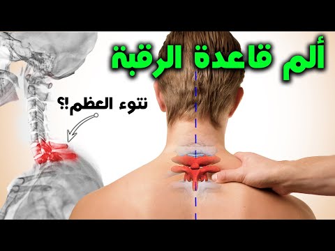 تخلص من ألم قاعده الرقبة || نتوء عظم الظهر || Cervicothoracic Joint Dysfunction