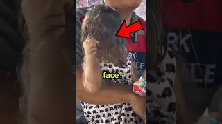 What Does It Really Mean to Have Hypertrichosis? #healthtips #werewolfsyndrome #shorts