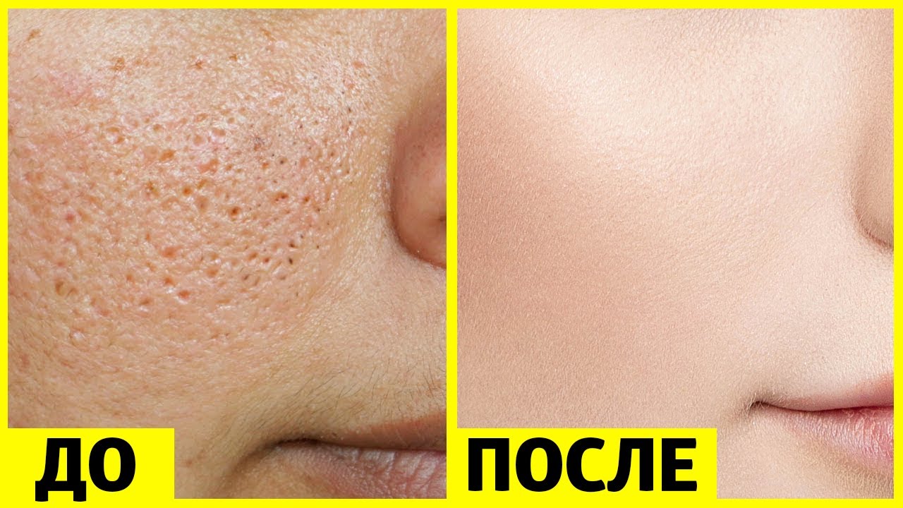 Как избавиться от больших пор и получить гладкую кожу за неделю