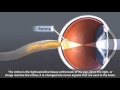 Understanding Cataracts