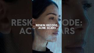 This acne treatment transcended her life! #acnescarhealing #beverlyhillsinjector