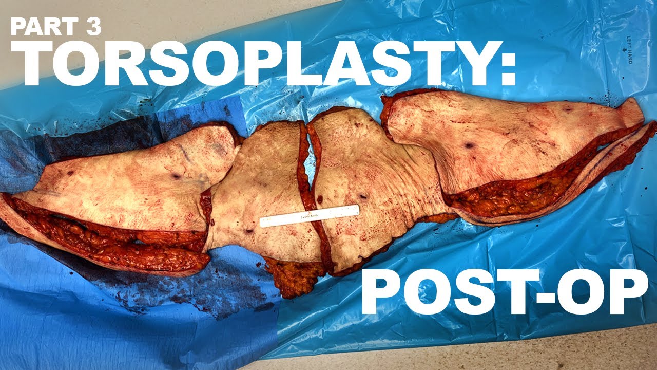 Post-operative torsoplasty surgical result displayed.