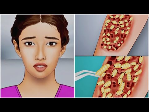 Treatment of infected girl / removal of pimples and blackheads using animation ASMR