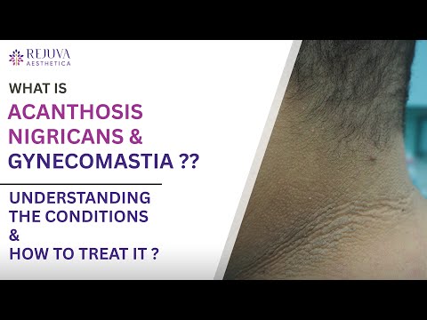 Acanthosis Nigricans & Gynecomastia explained – causes, symptoms, & best treatment options revealed!