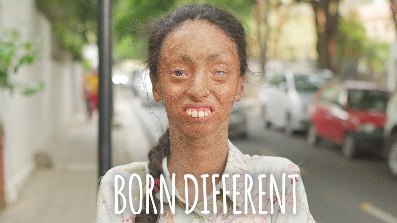 The girl whose skin peels off - born different