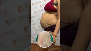 Tummy Tuck Feedback | Tummy Tuck Result | Tummy Tuck