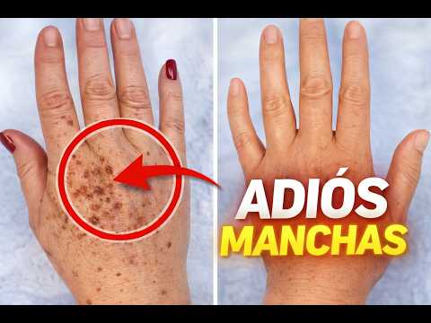 ¿Manchas Oscuras en las Manos? Haz Esto (Natural y Rápido