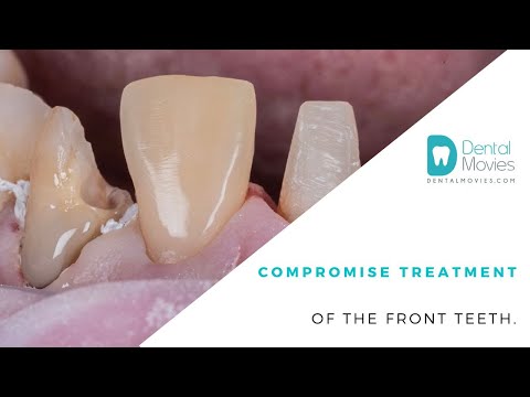Compromise treatment of the front teeth