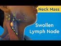 Lymph Node Surgery and Care