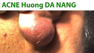 Acne Treatment Huong Da Nang#738  Acne in Ears #shortvideo part 2