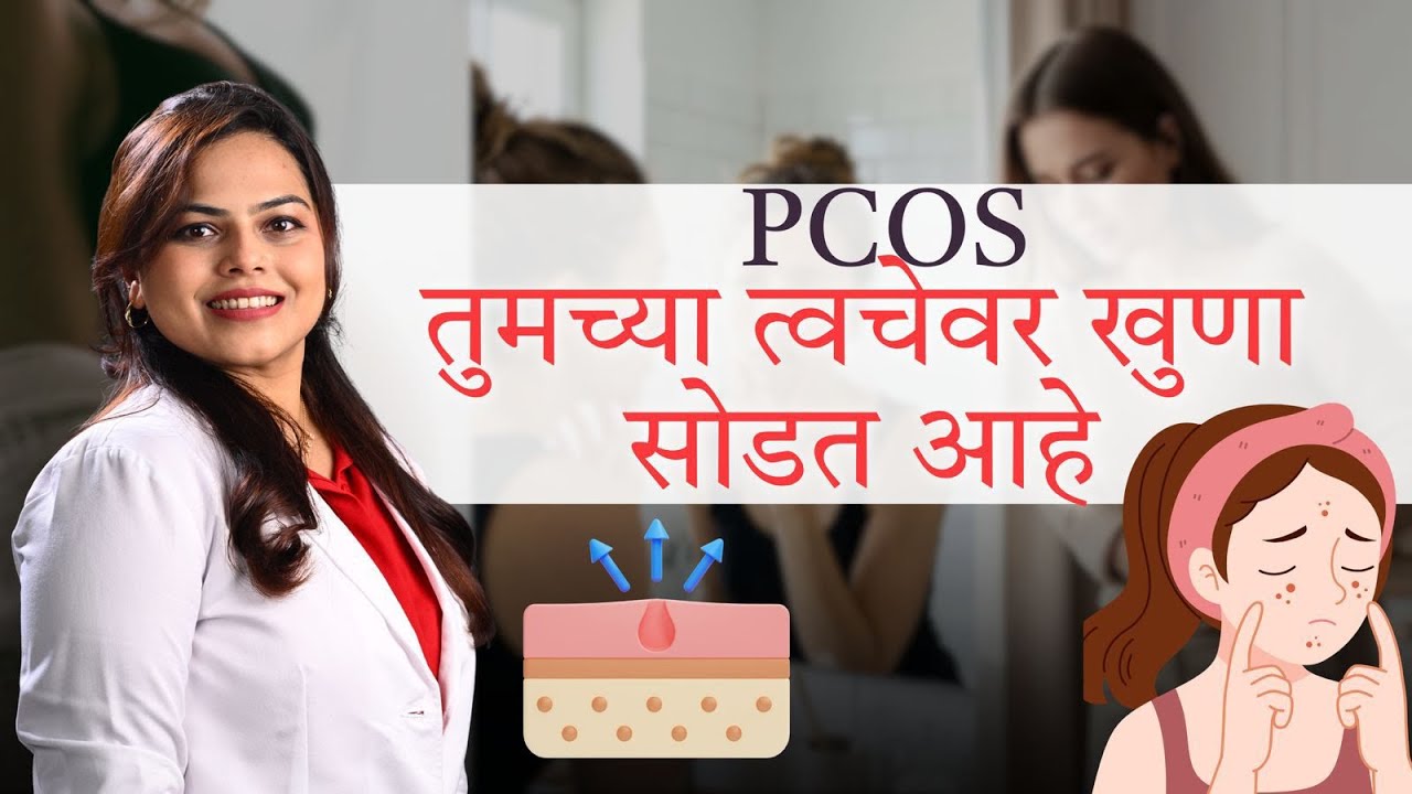 PCOS and Skin Problems Dermatologist Interview Thumbnail