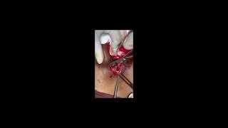 Pilonidus Surgery: What to Expect Before, During, and After