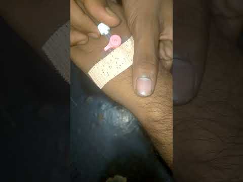 IV Cannulation Technique Porcedure