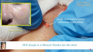 Doughnuts on the skin? Sebaceous Hyperplasia