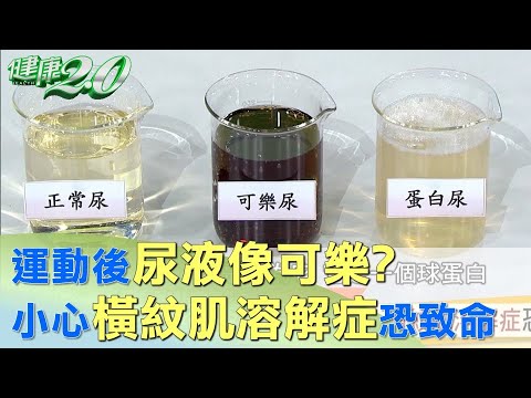 運動後尿液像可樂？小心橫紋肌溶解症恐致命 健康2.0