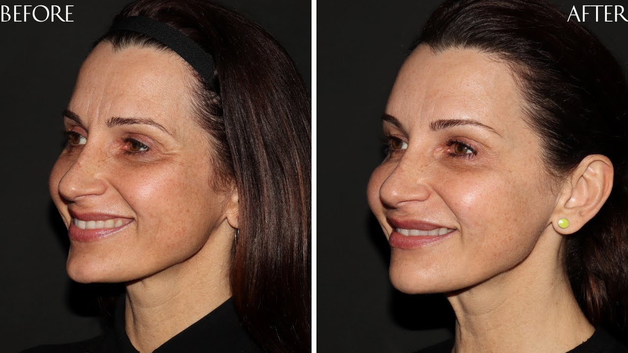 Preview of Dermal filler and Botox Cosmetic ® : Lisa 47 y.o.