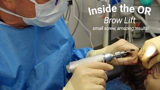 Inside the OR: Brow Lift with Dr. Bunkis