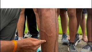 Varicose Veins से ज़ल्द छुटकारा कैसे पाएं | ARMY MEDICAL | नीली नशें या बंद नशों को खोलना ये करें 