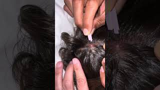 We Found a BOT FLY in Our Son's Skin!!