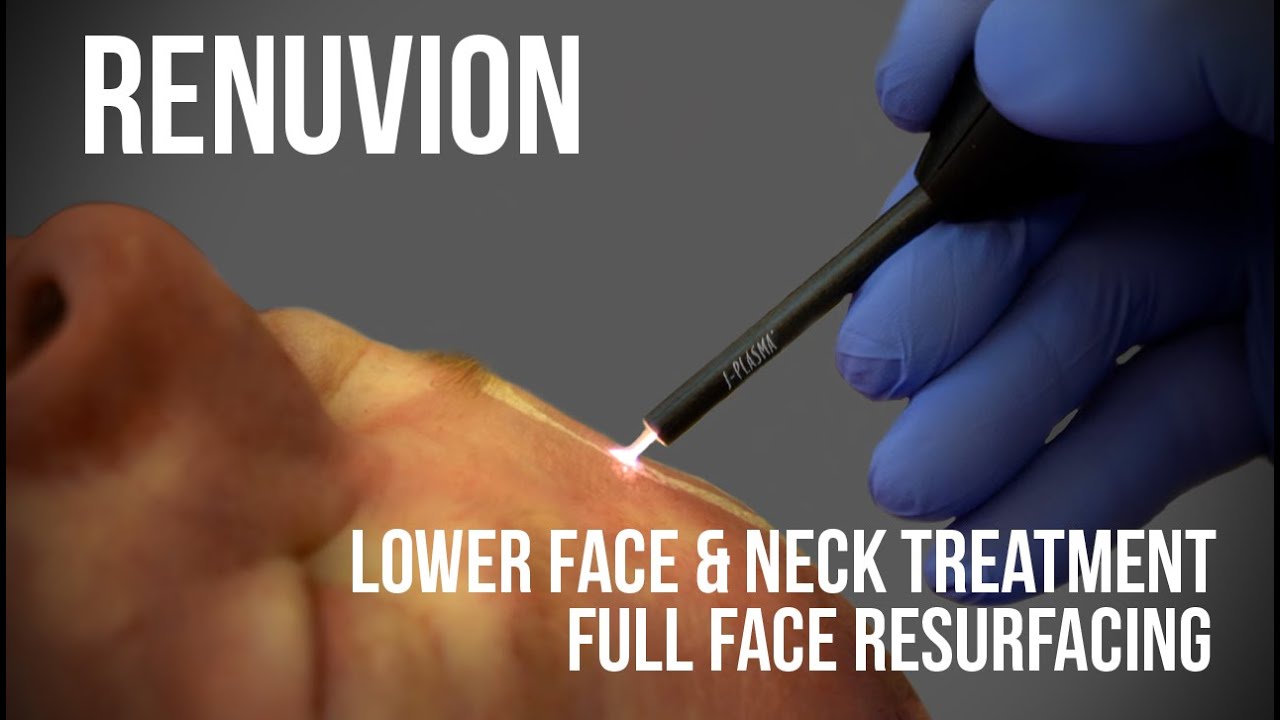 Renuvion lower face and neck treatment procedure.