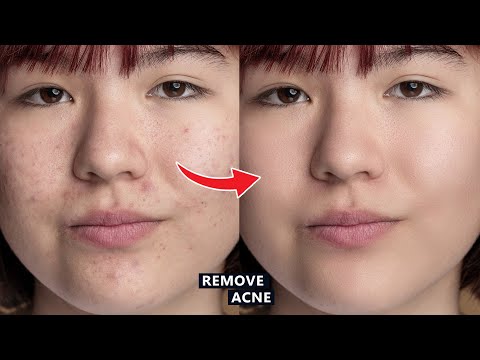 How to Remove Acne in Adobe Photoshop  Tutorial for beginners