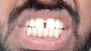 दाँतों का गैप और बाहर निकले दाँत अब नहीं ! Zirconia Crown Solution