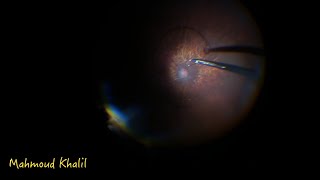 Not just a dropped CTR, an intraoperative surprise