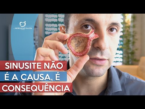 Sinusite Não é Causa é Consequência