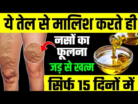 बस यह उपाय कर लो 10 दिन में गायब होगा Vericose Vein|Vericose Vein Exercise|Vericose Vein Problem