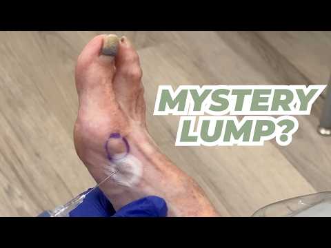 Mystery or Ganglion?