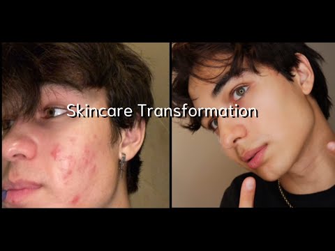 How I cleared up my skin