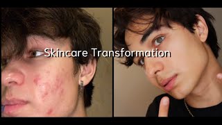How I cleared up my skin