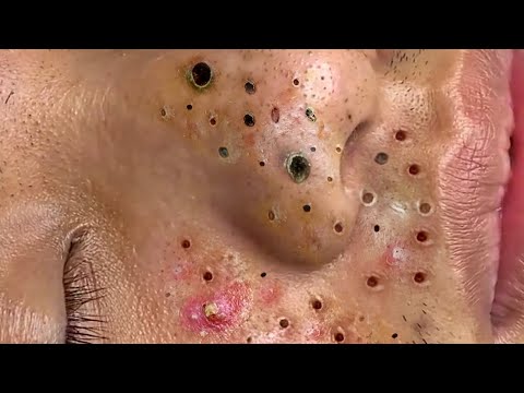 Blackhead Removal With Today Spa #2441