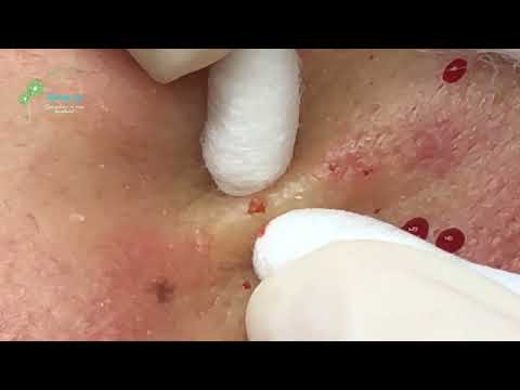 Blackheads & Acne Treatment Latest Update Dec-11-24 02