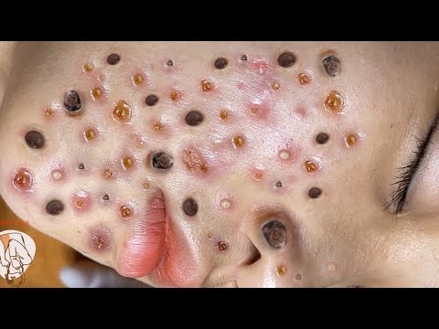 Blackhead Removal With Sac Dep Spa @100074047