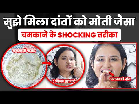 आयुर्वेदिक दवाई से दातो की चमक के लिए मेरा 21 दिन का चमत्कारिक प्रयोग! Teeth Whitening At Home