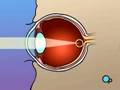 Understanding PRK Laser Surgery Concepts