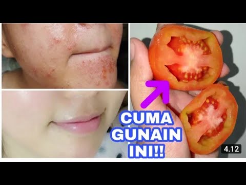 CARA CEPAT‼️MERONTOKKAN BRUNTUSAN & MILIA PADA WAJAH//BONUS KULIT CERAH GLOWING