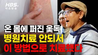 온몸에 퍼진 옻독 병원치료 안되서 이 방법으로 치료했다